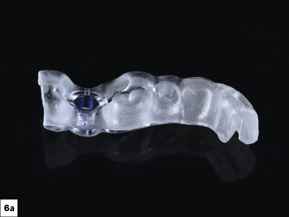 Tooth-supported surgical guide (Side View)