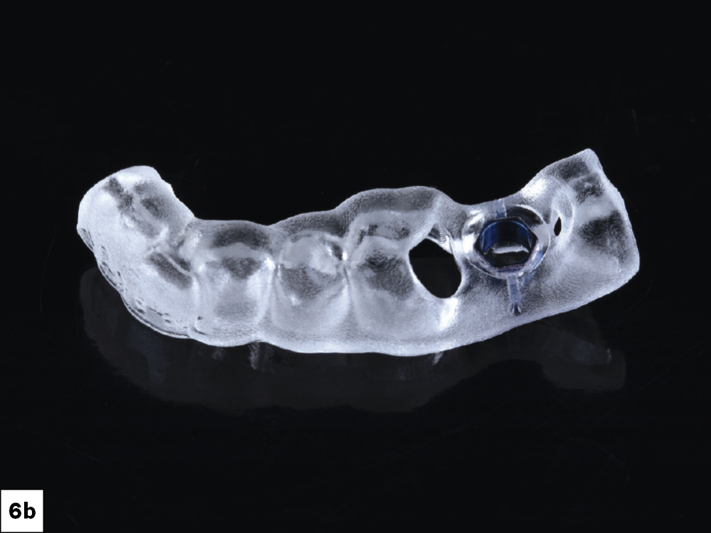 Tooth-supported surgical guide (Top View)