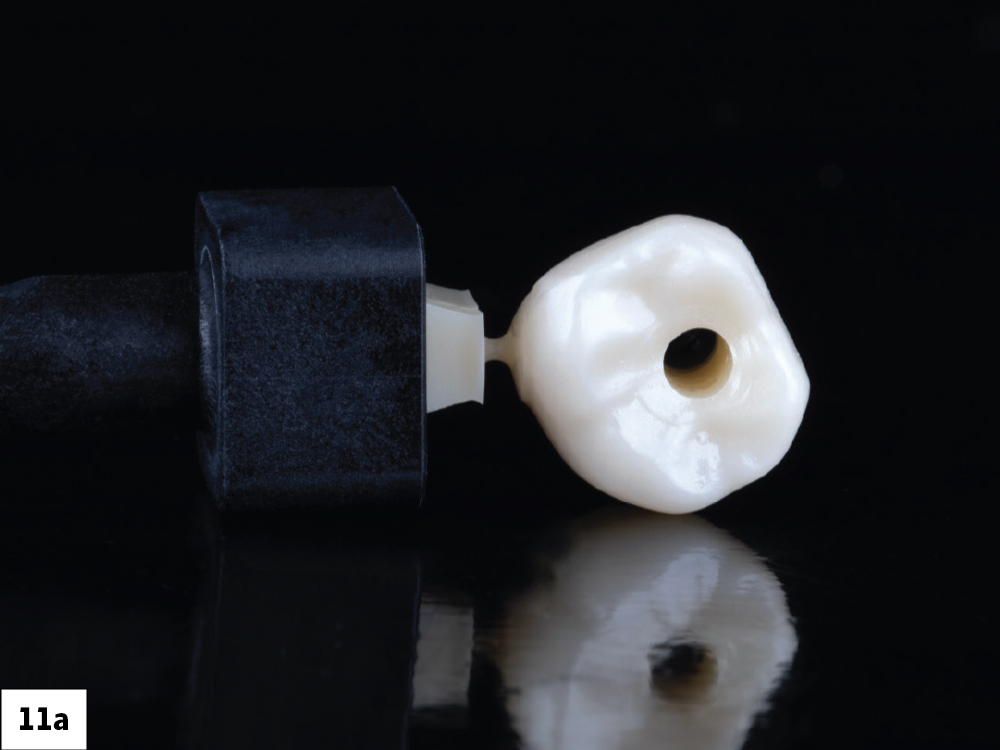 BruxZir screw-retained crown (top view)