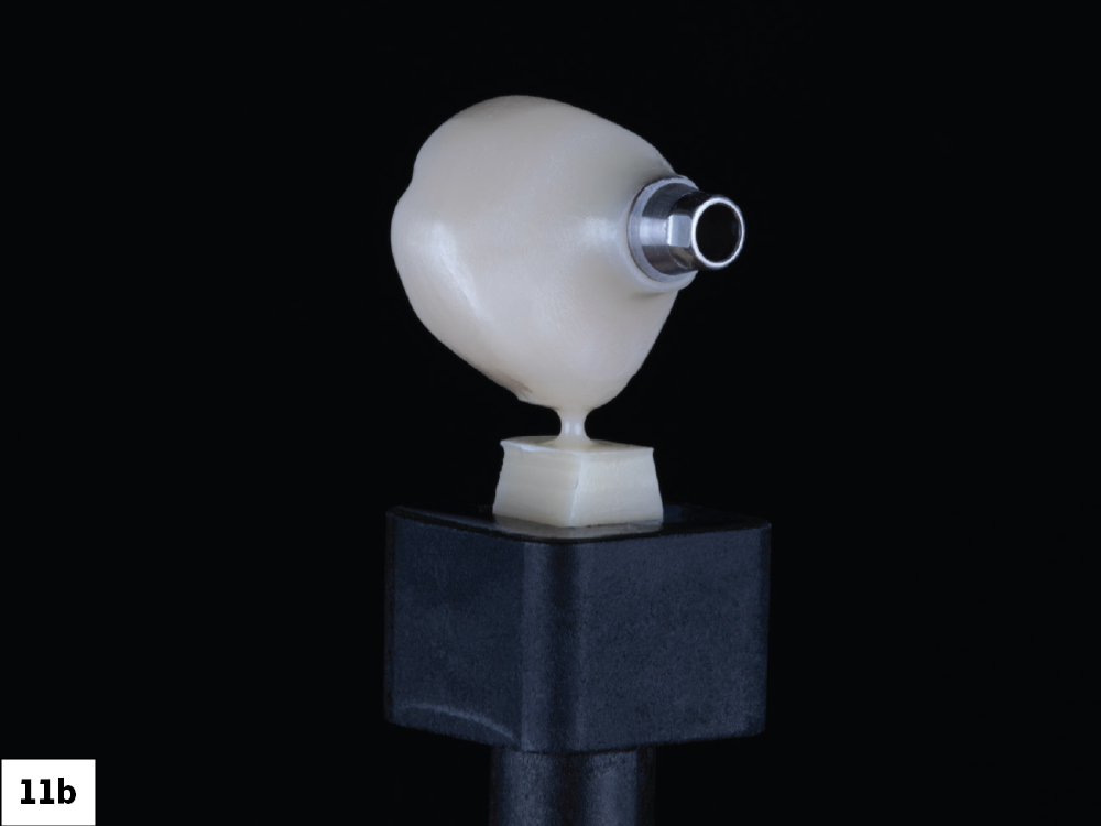 BruxZir screw-retained crown (side view)