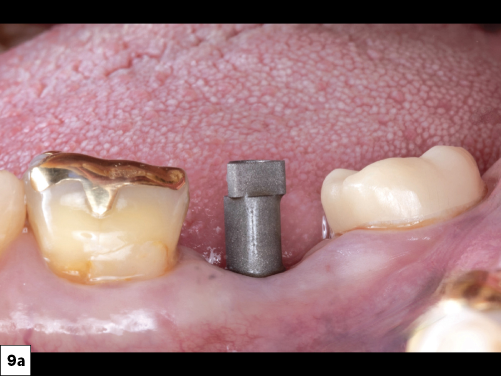 Inclusive Titanium Scan Body