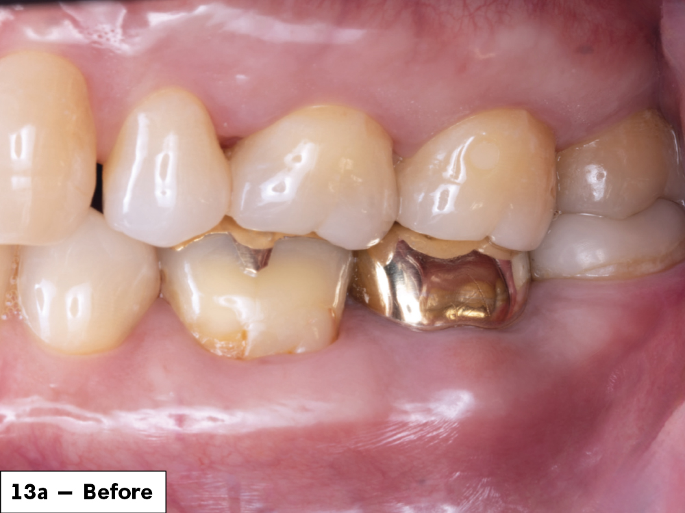 Before tooth surgery