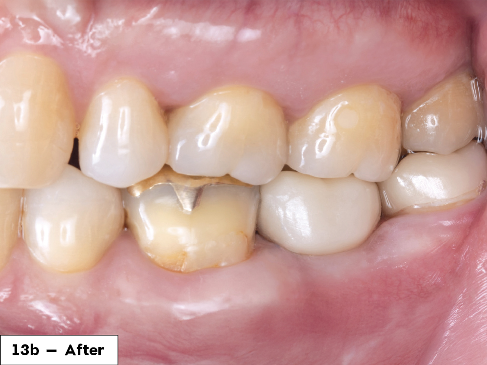 1 year after tooth surgery