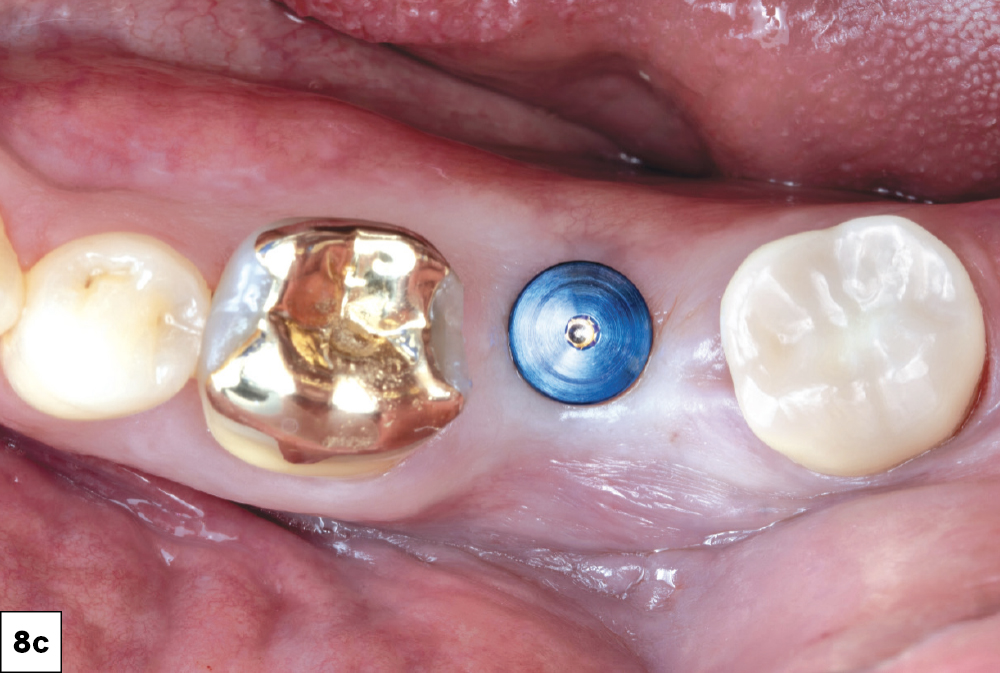 Glidewell HT Implant torqued into place