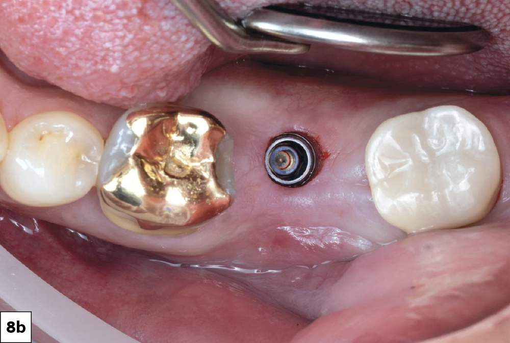 Guided drilling protocol