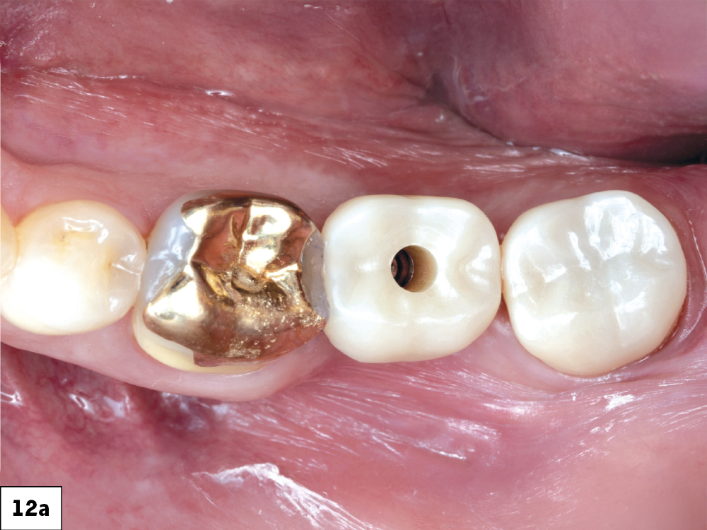 BruxZir NOW SRC in mouth with open access channel