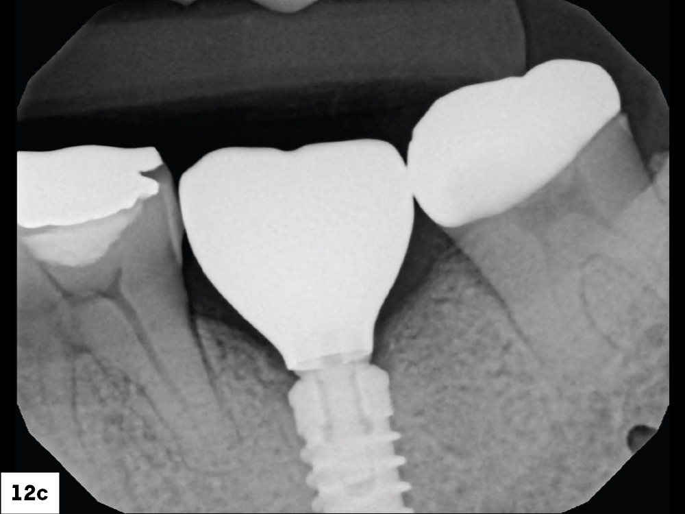 BruxZir NOW SRC in mouth radiograph