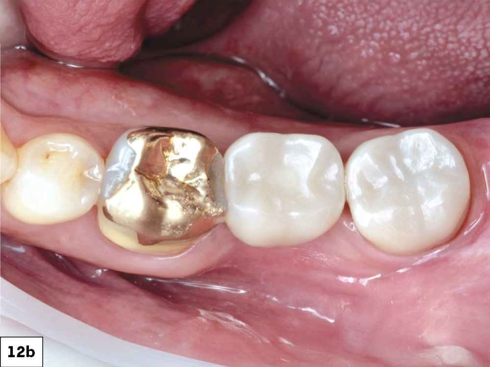 BruxZir NOW SRC in mouth with closed access channel