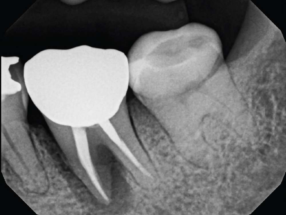 Radiograph of tooth