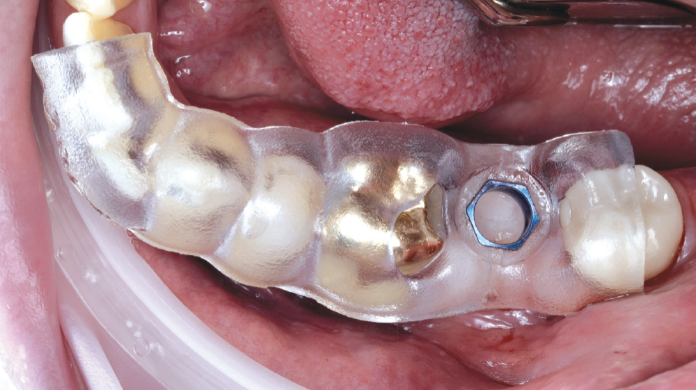 Tooth-supported surgical guide in mouth
