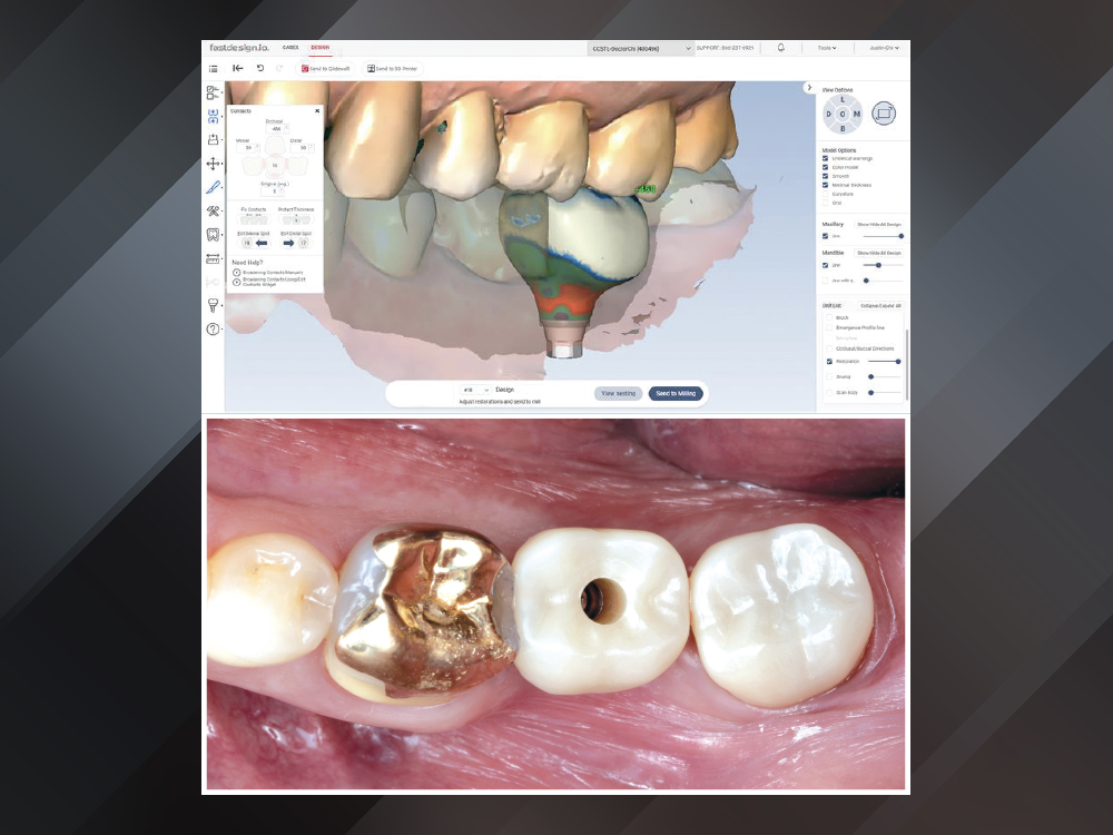 Single-Unit Implant Restoration Milled with BruxZir NOW SRC