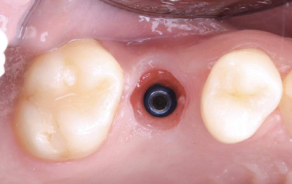 Healing cap removal, scan, design