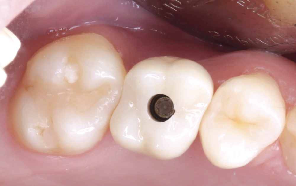 delivery of a BruxZir® SRC NOW crown were all done on the same day