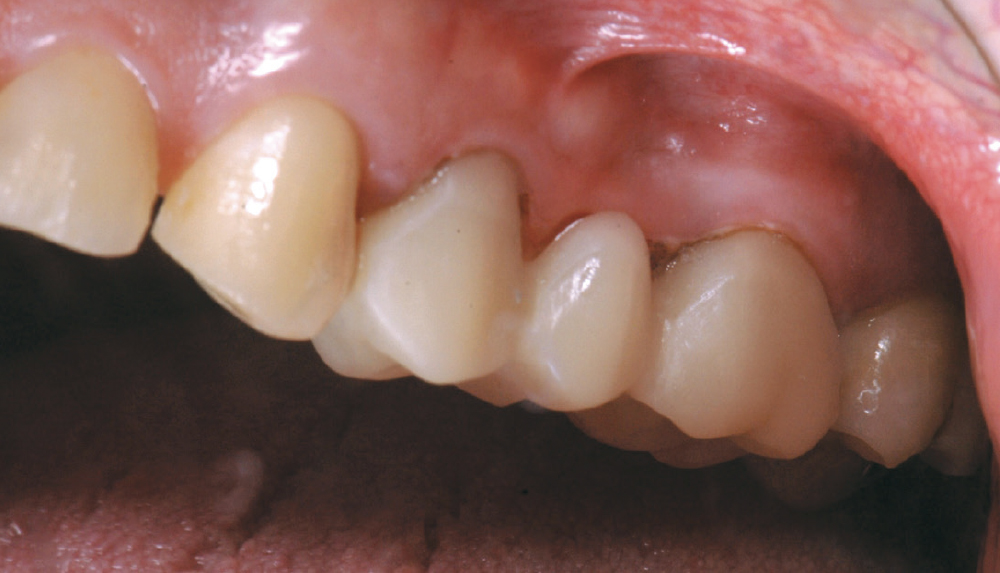 A crown milled from a BioTemps NOW Milling Block