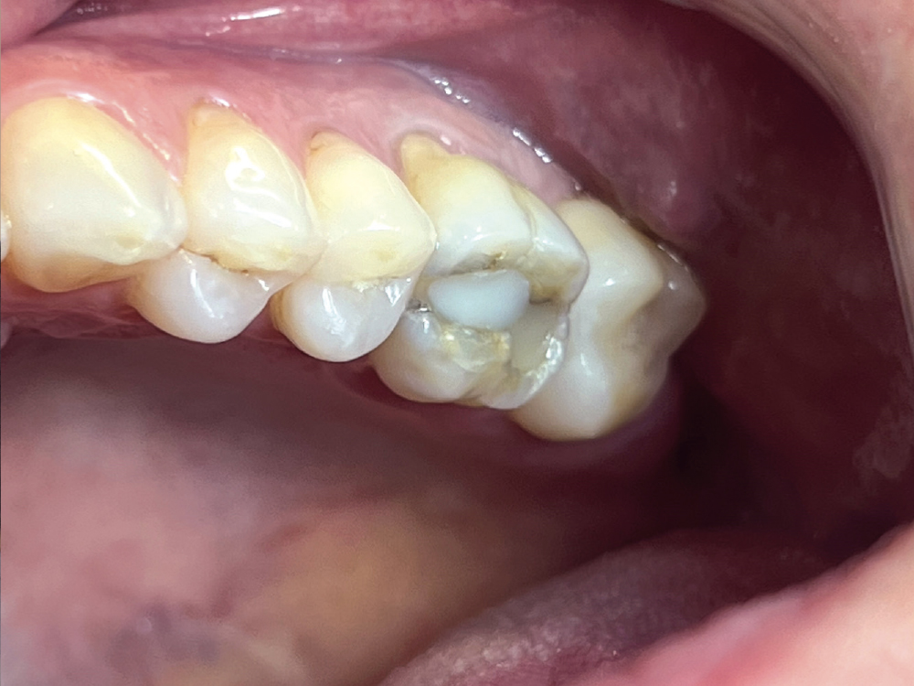 The patient needed a broken molar restored.