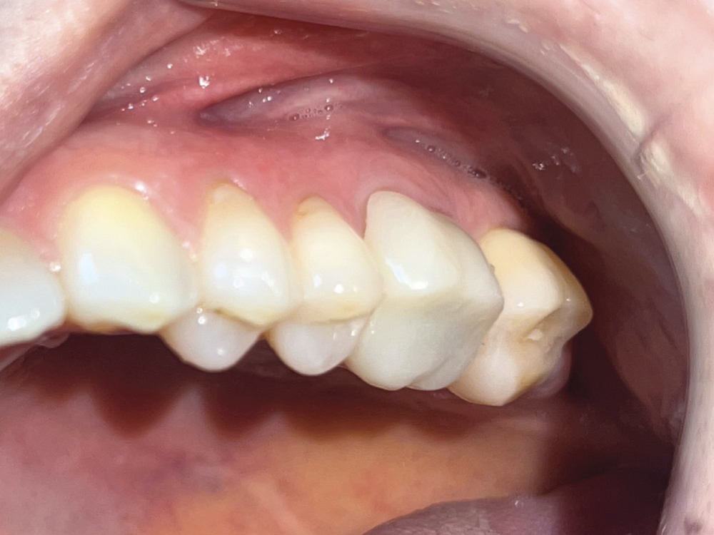 crafted crown milled from a BruxZir® Esthetic NOW Posterior Milling Block