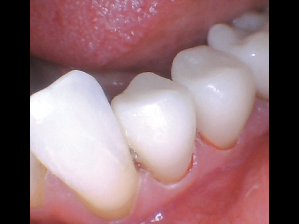 replaced with two Obsidian® NOW crowns for a great combination