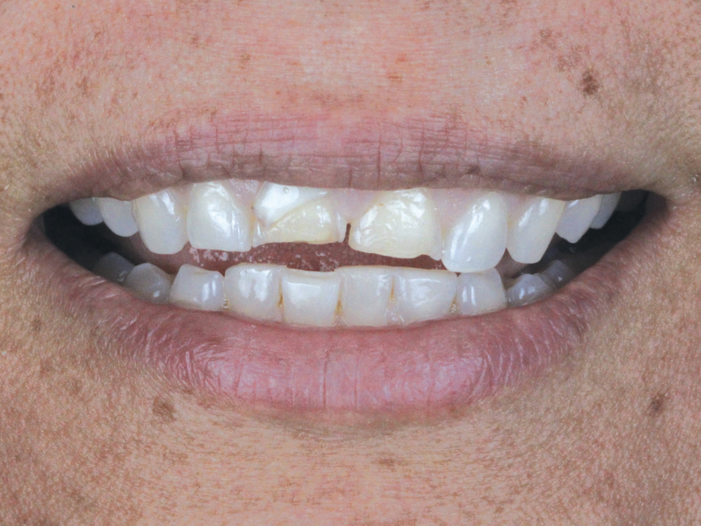 This patient wanted to correct her smile