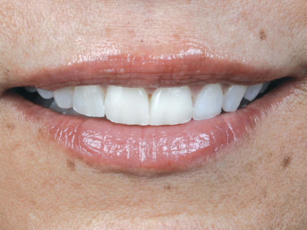 Veneers were designed, milled and placed