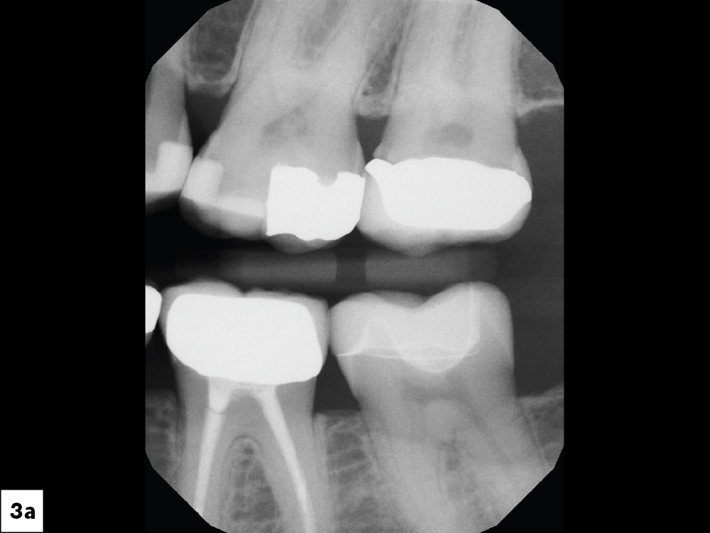 the treatment plan called for restoration of the tooth