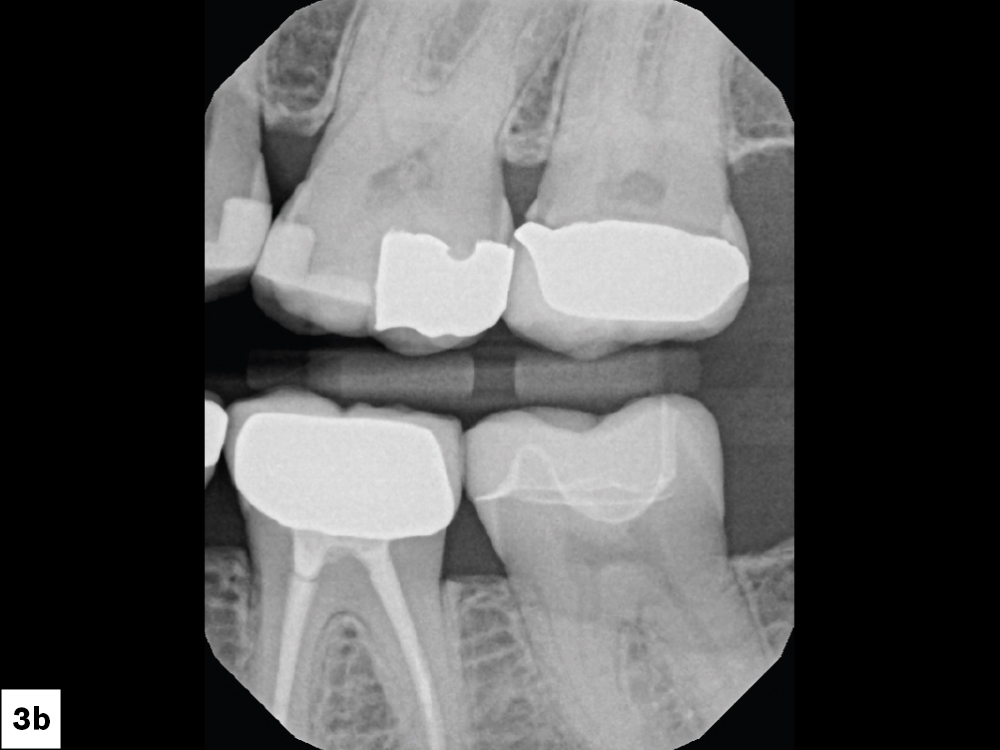 Radiographs verified the open margin