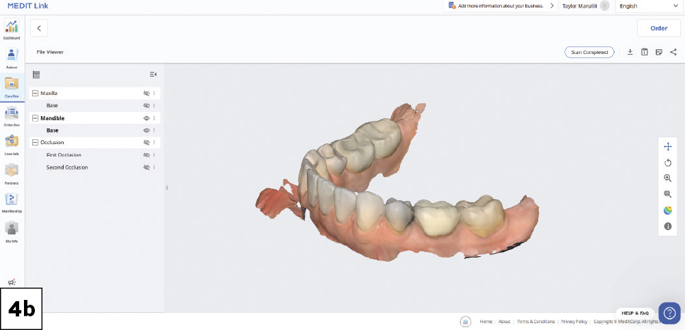 A pretreatment scan of the maxillary and mandibular arches and bite was done prior to delivery of local anesthetic-2