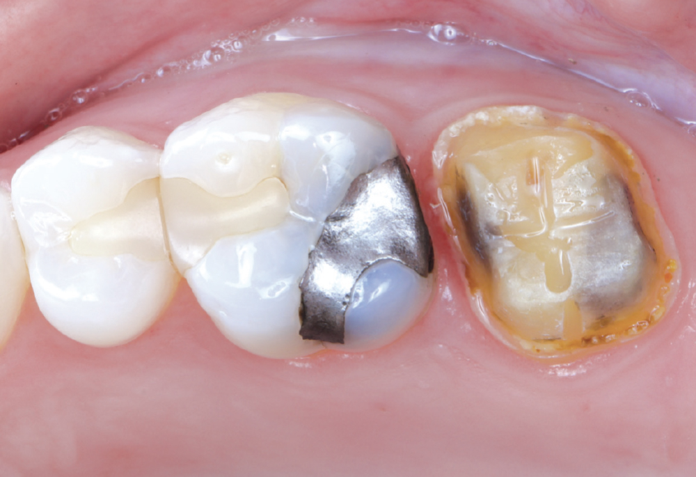 There were some recurrent caries on the mesial of #15 where the margin was open
