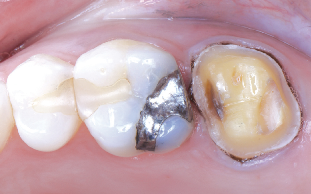 After refinement of the tooth preparation, the margin was exposed using the two-cord technique