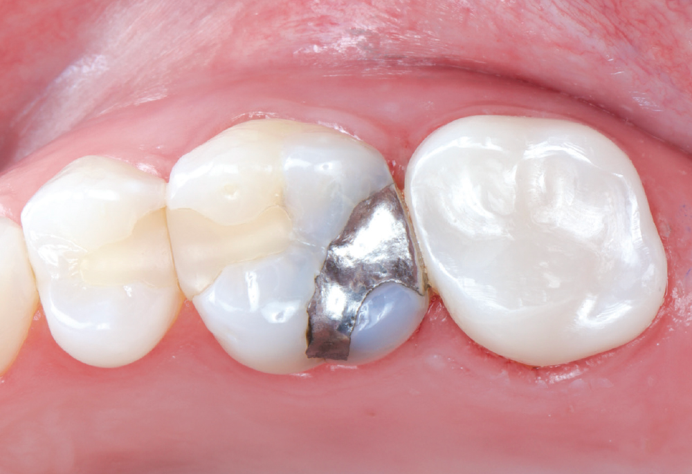 The crown was a 20-year-old Captek™ PFG high-noble bilayered restoration