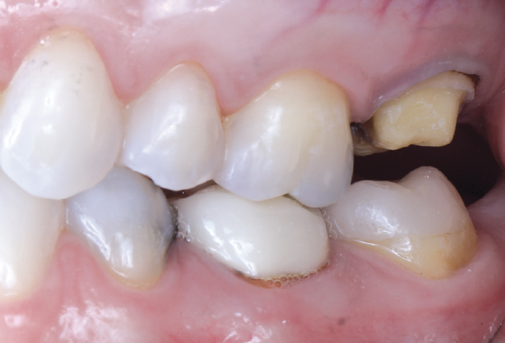 Clinical evaluation of the occlusal reduction ensured there was adequate space for the restorative material