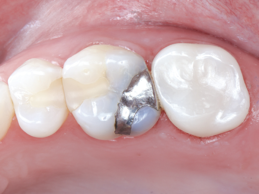 The crown was a 20-year-old Captek™ PFG high-noble bilayered restoration