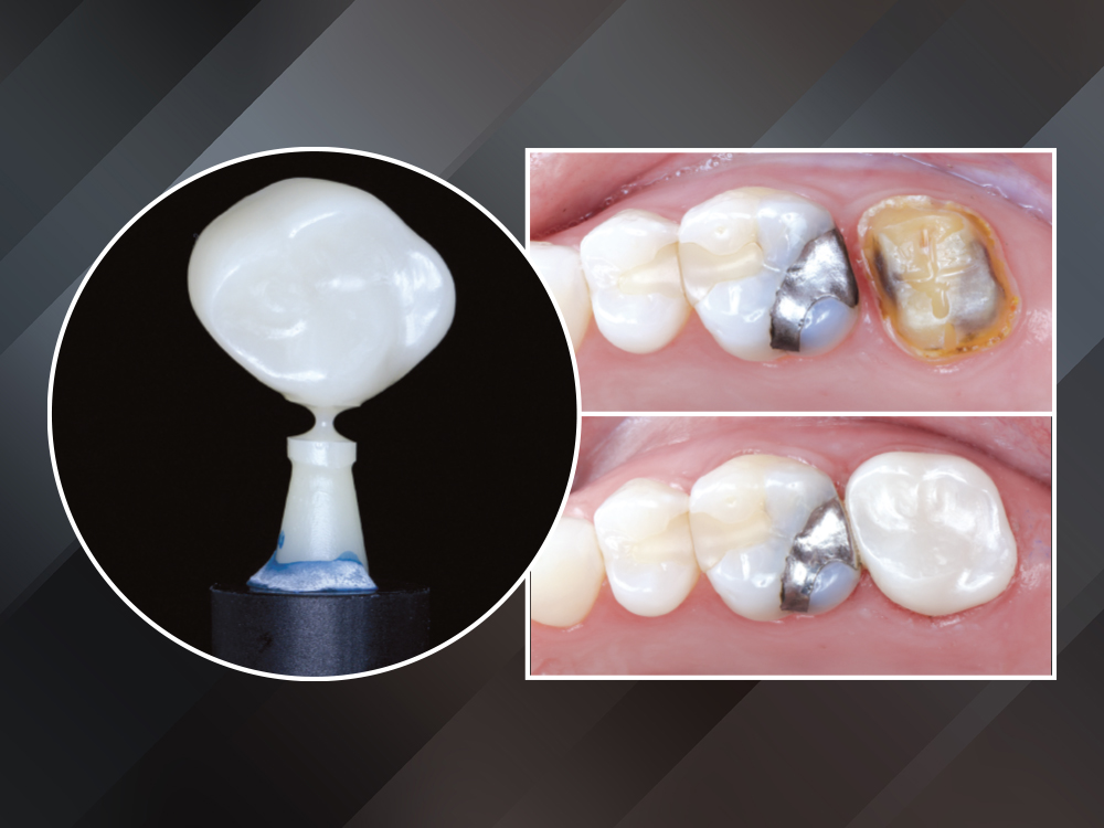 Replacing a Single Posterior Crown in One Appointment