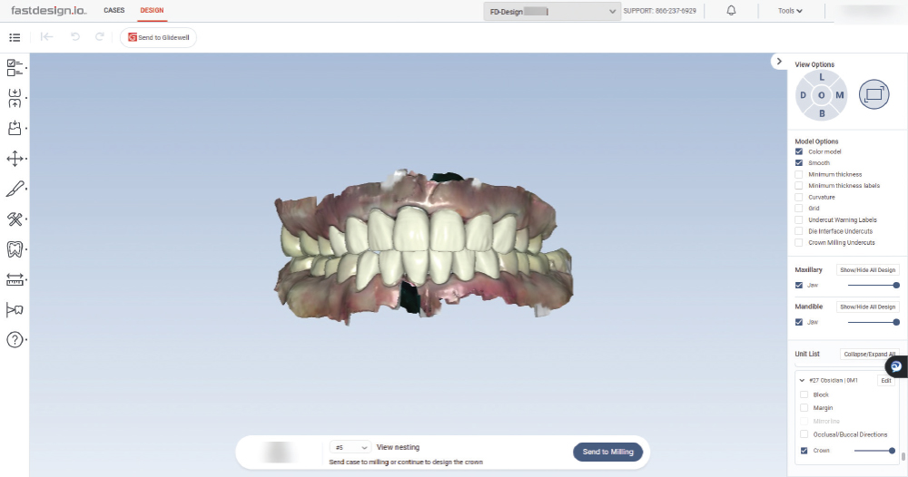 Anterior design for the 28-unit full-mouth rehabilitation