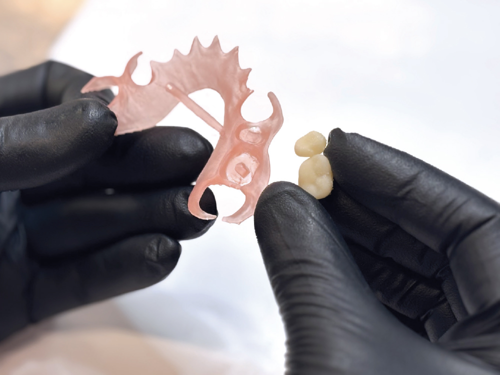 Flexible Partial before teeth are bonded