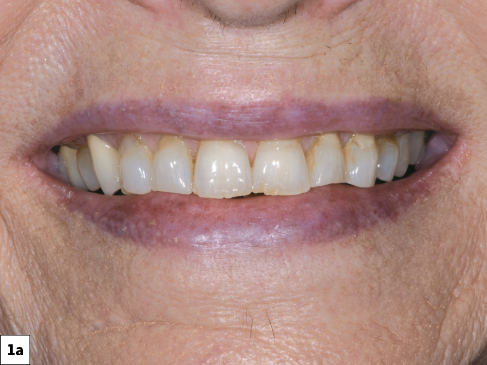 The patient presented with failing Class V restorations, cervical wear, discoloration and chipping of the incisal edges