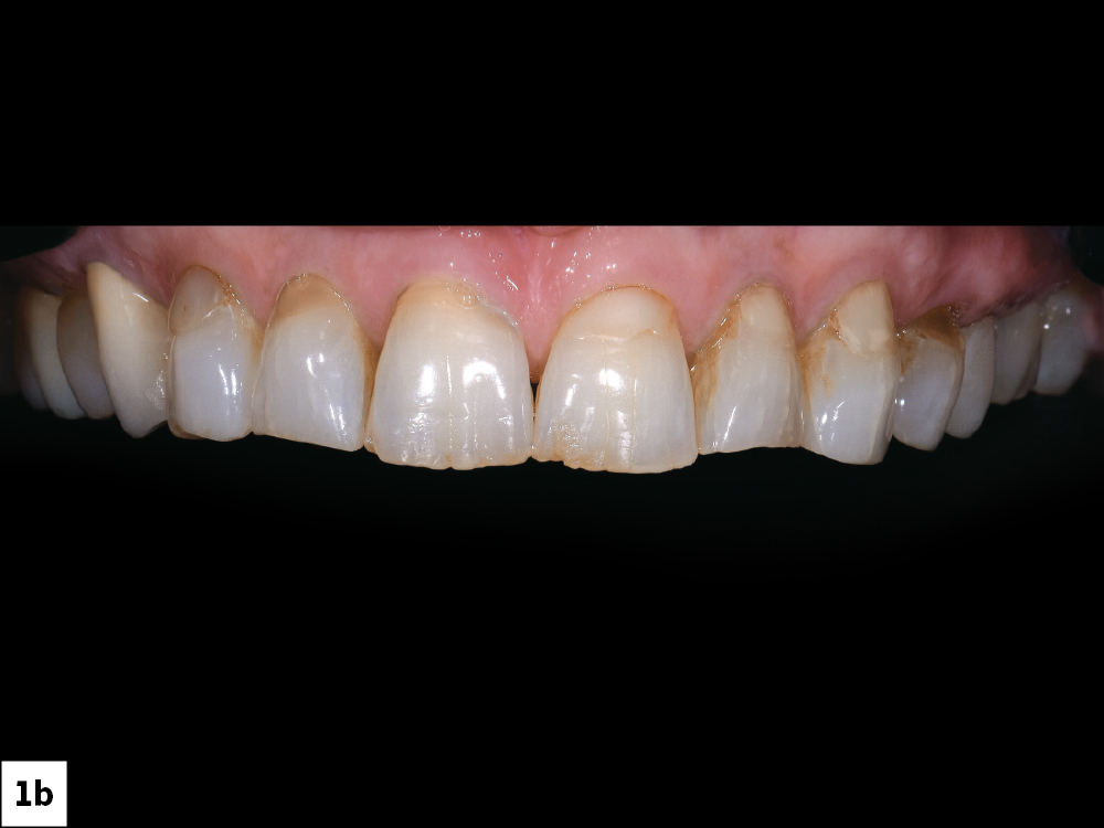 The patient presented with failing Class V restorations, cervical wear, discoloration and chipping of the incisal edges