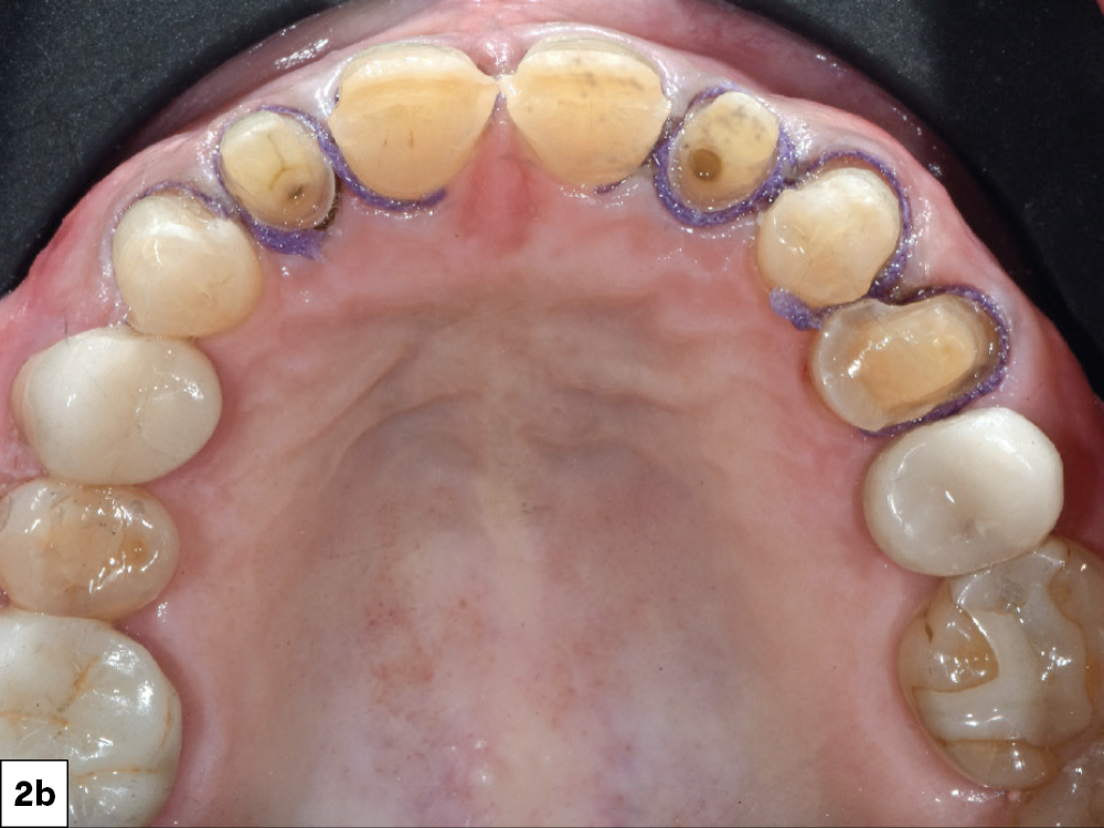 A gingivectomy was performed on teeth #8 & #9
