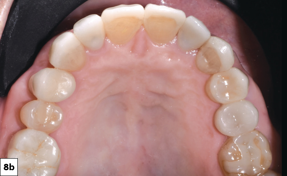The restorations were seated with Variolink® Esthetic resin cement (Ivoclar Vivadent)