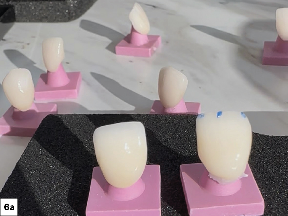 applied MiYO® Translucent Shade A (Jensen Industries Incorporated; North Haven, Conn.)