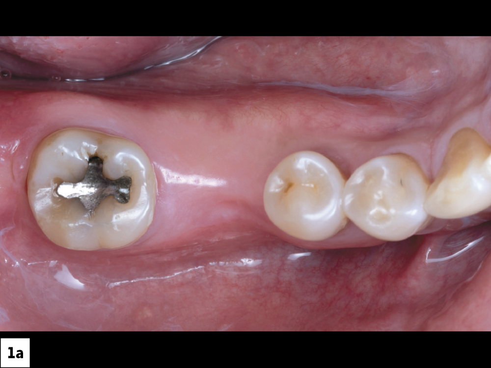 Gum Ridge with Adequate Width for Implant