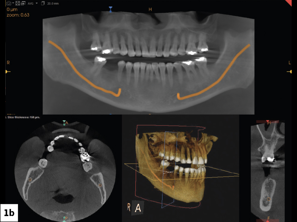 CBCT Scan and Intraoral Measurements to Determine Ridge Dimensions