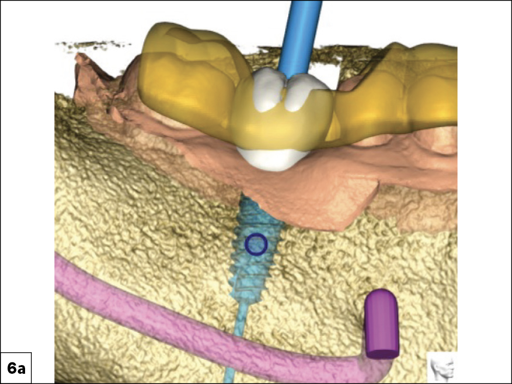 CBCT Scan Confirming Mixture of D3-D4 Bone