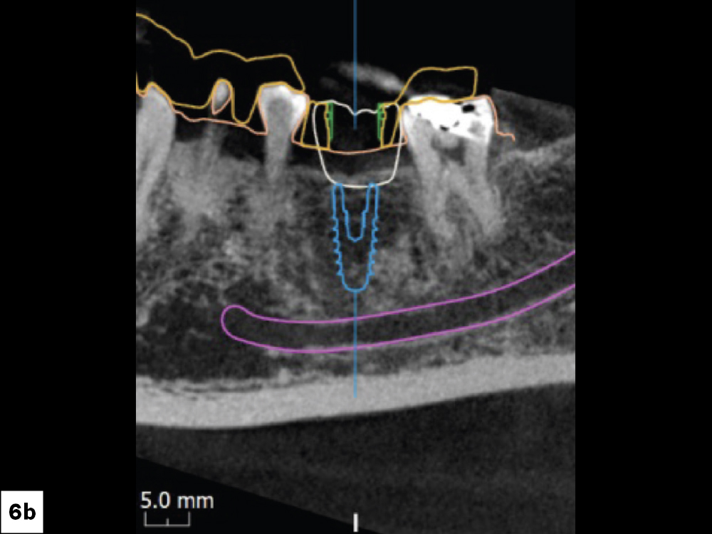 CBCT Scan Confirming Mixture of D3-D4 Bone