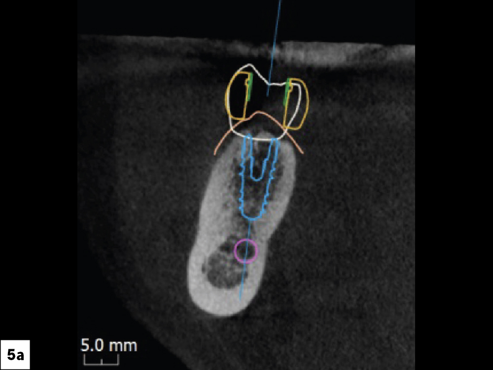 Occlusal View Which Indicates the Placement of the Surgical Guide
