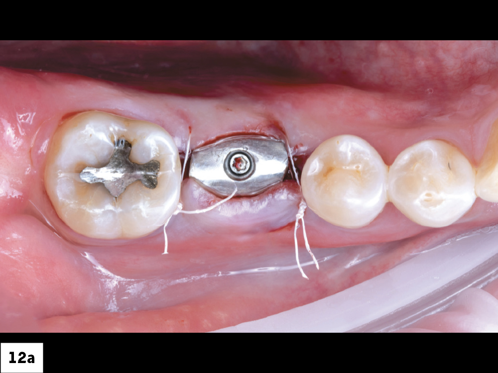 Two Sutures Placed Around the Implant Site