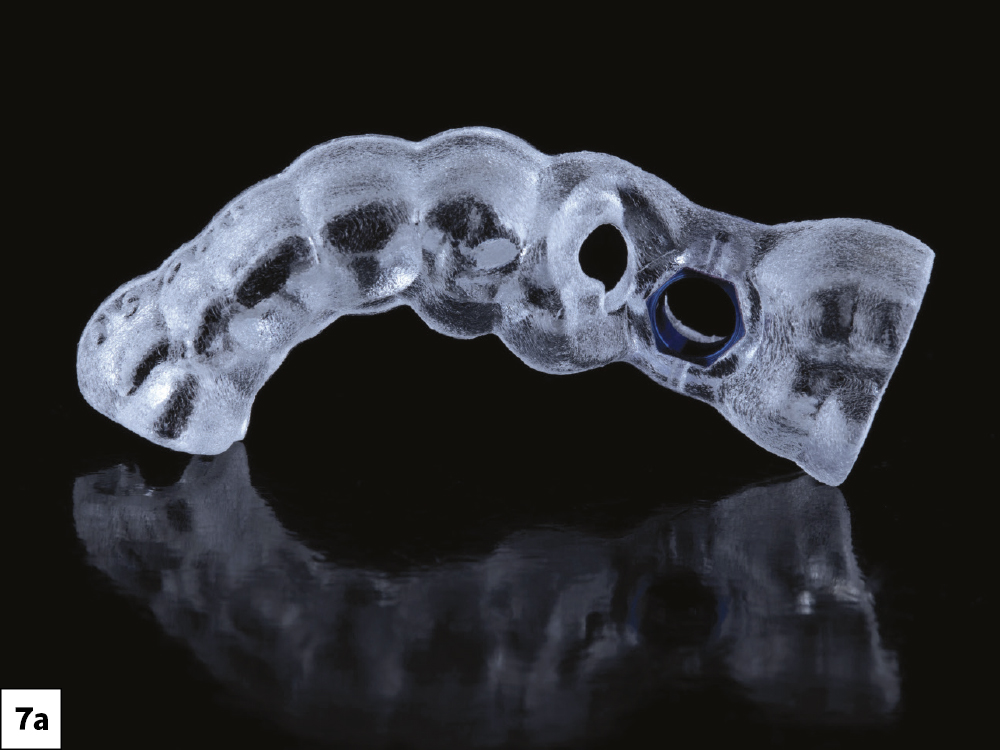 Glidewell Tooth Replacement Solution Bundle