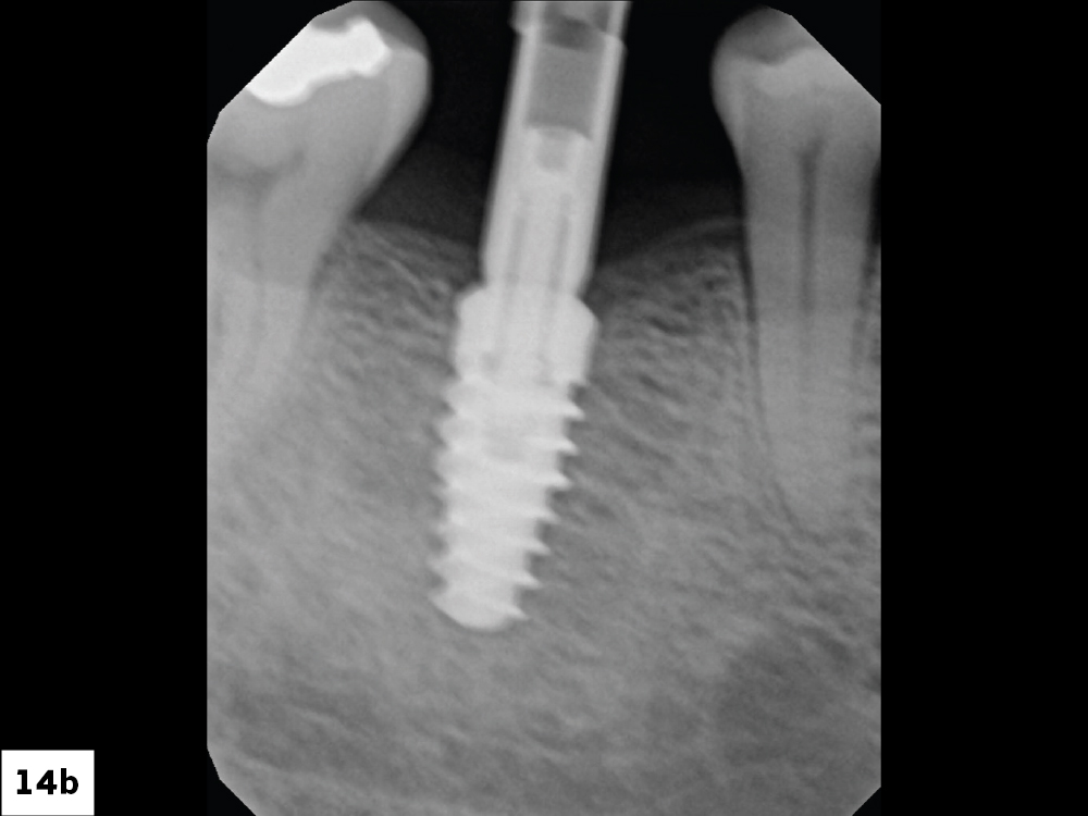 Radiograph to Confirm Proper Seating of Scan Body