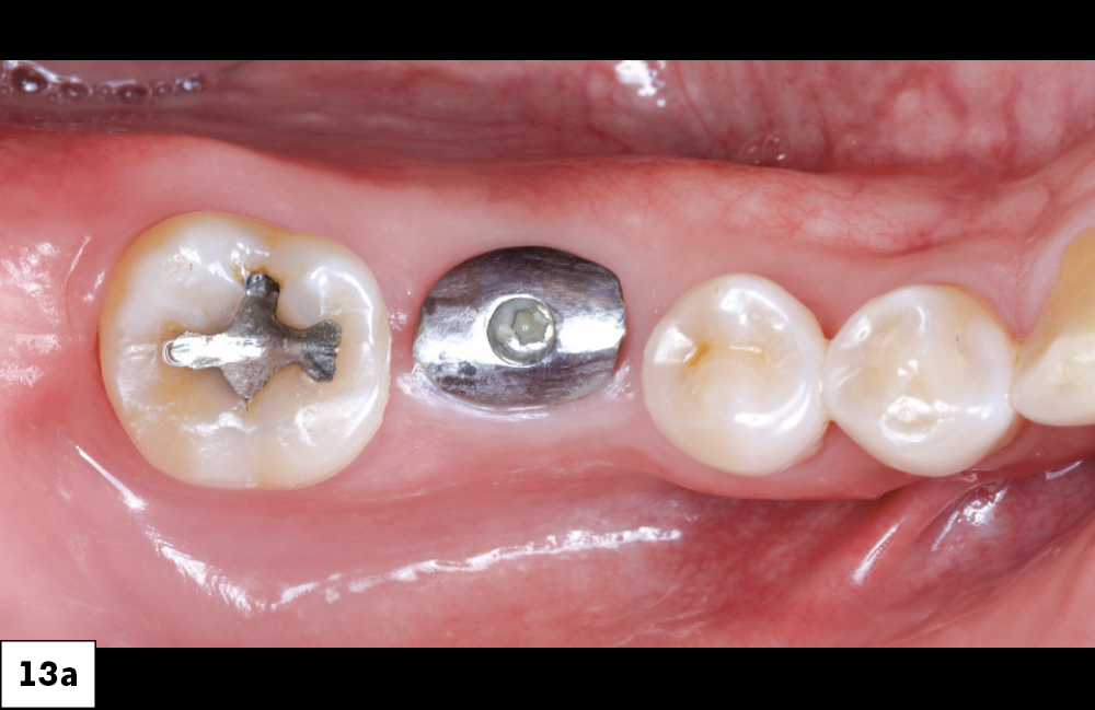 Follow Up Image of the Implant Site with Healing Abutment