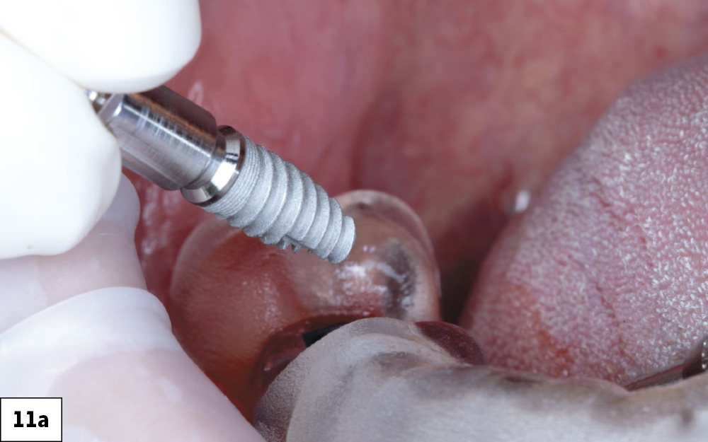 Osteotomy with 4.3/5.0mm Alignment Drill