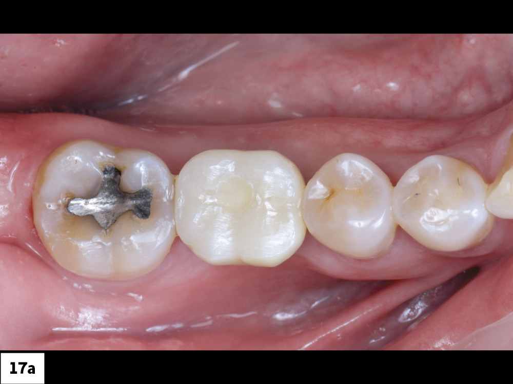 Final BruxZir Esthetic Screw-Retained Crown